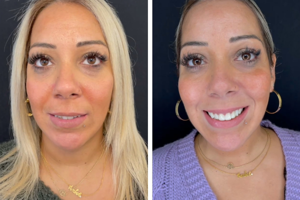 couronne ceramique et invisalign