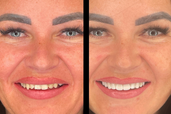 Invisalign & veneers